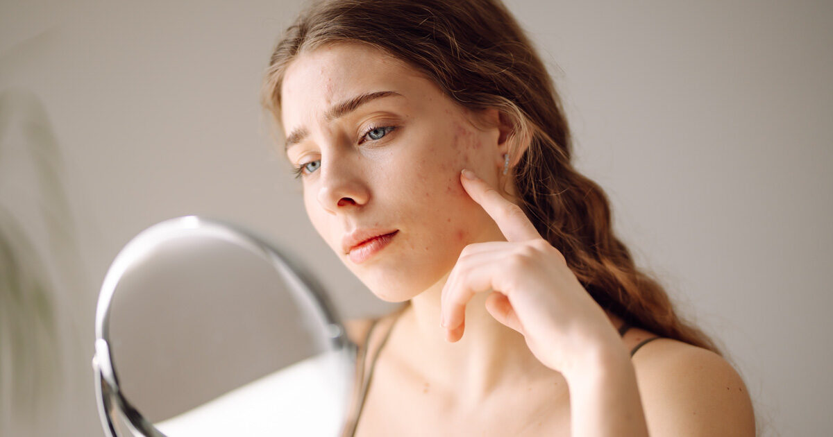 Ακμή Πρόσωπο